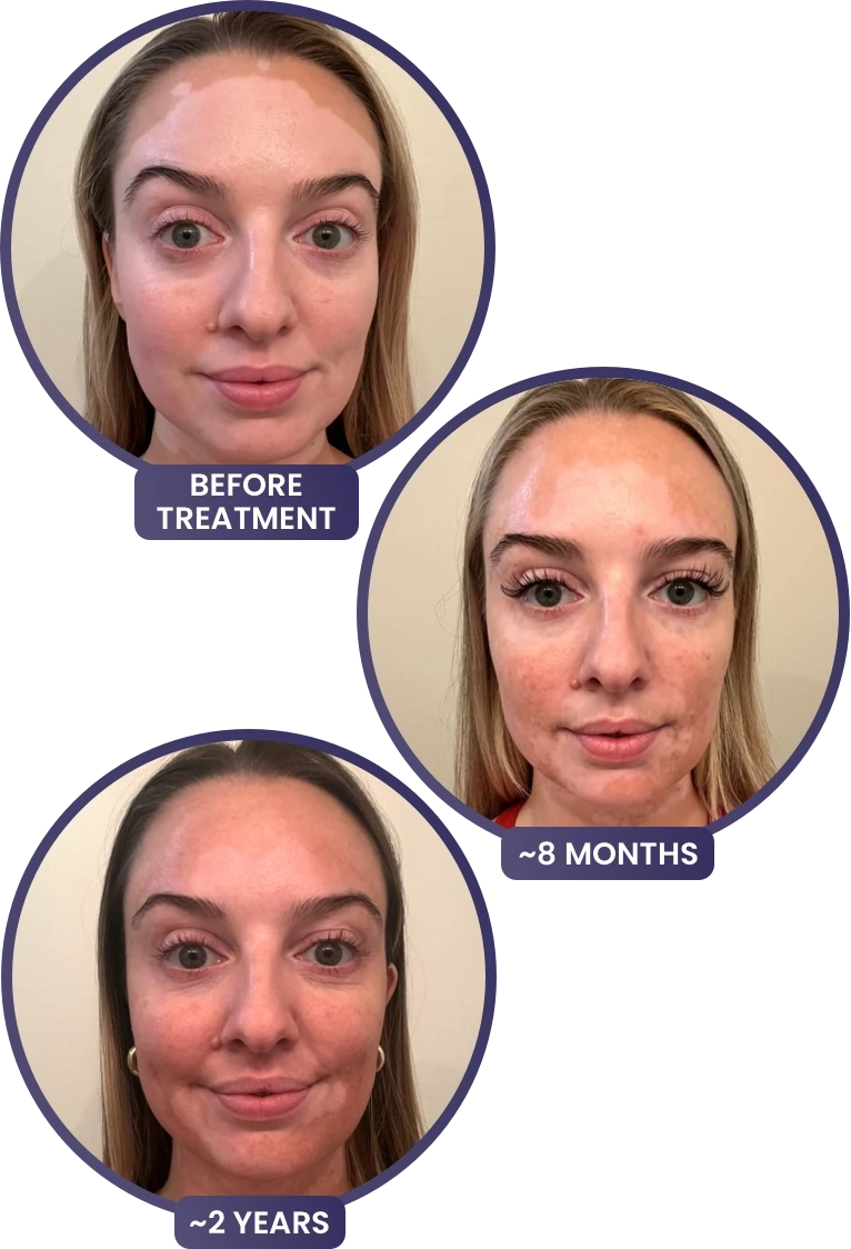 A young woman's face with vitiligo, showing depigmentation before treatment with OPZELURA and more repigmentation progress at 8 months and 2 years of treatment with OPZELURA.