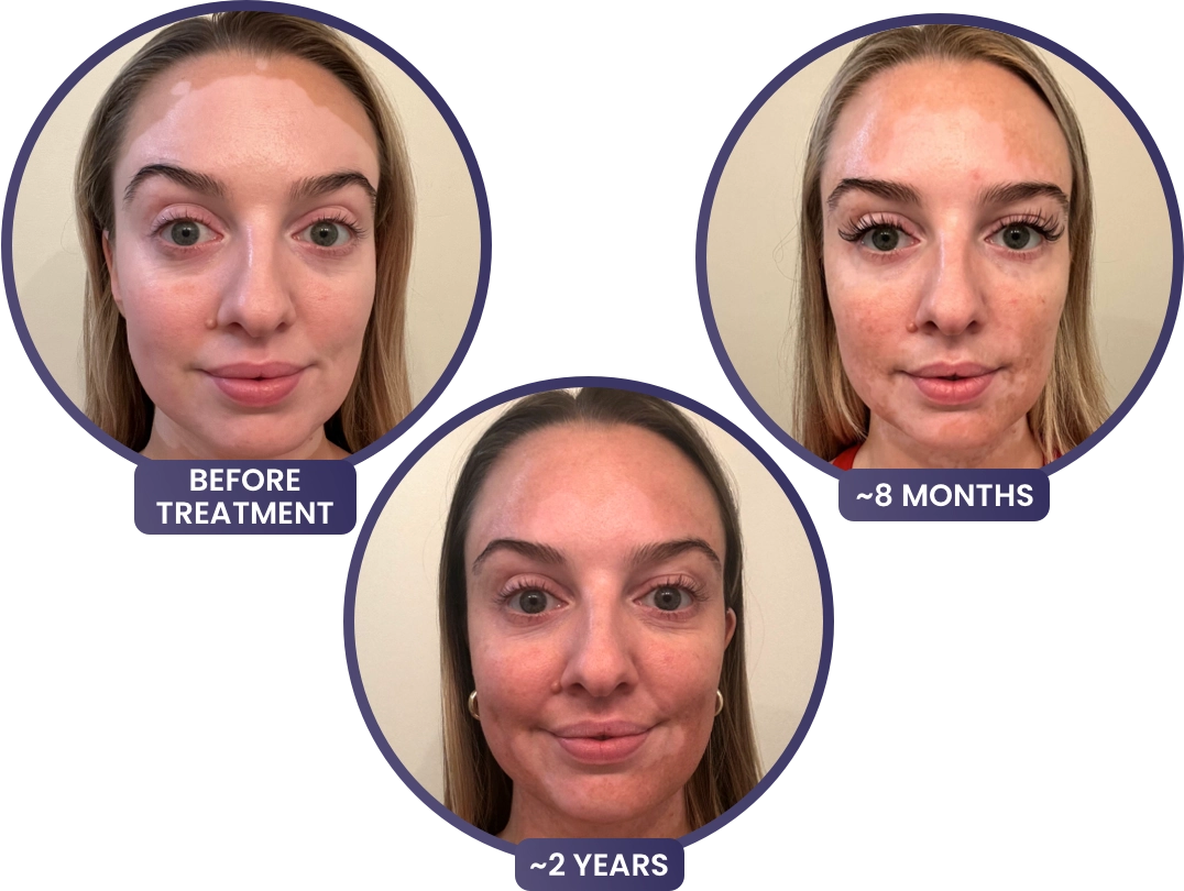 A young woman's face with vitiligo, showing depigmentation before treatment with OPZELURA and more repigmentation progress at 8 months and 2 years of treatment with OPZELURA.